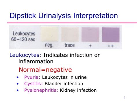 Leukocytes in Urine: Typical Levels, Causes, Symptoms, and .
